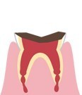 歯の根だけが残った虫歯のイラスト