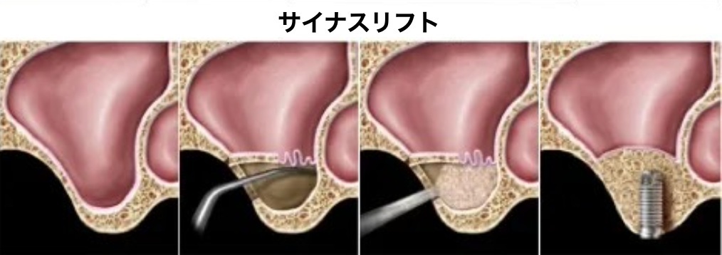 サイナスリフトの手術工程の図