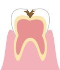 象牙質まで進んだむし歯のイラスト