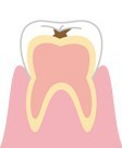 エナメル質の虫歯のイラスト