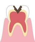 神経に達するむし歯のイラスト