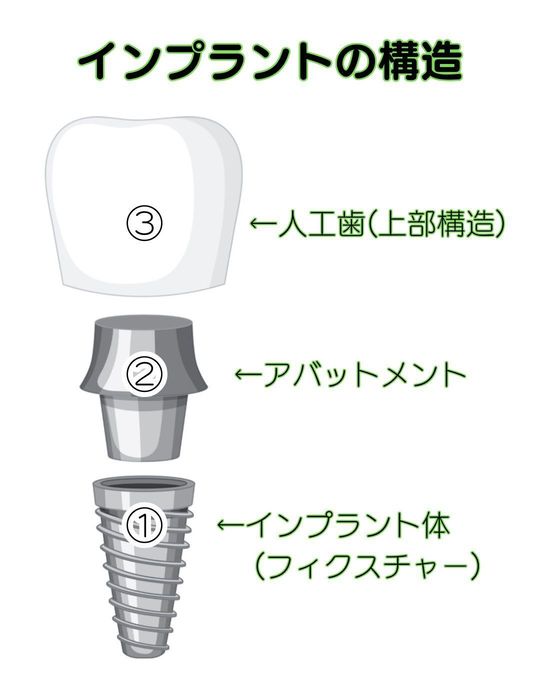 インプラントの治療 - はりなかの歯科(針中野駅)